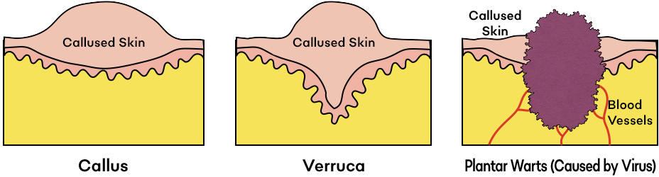 Illustration of foot care for callus and wart