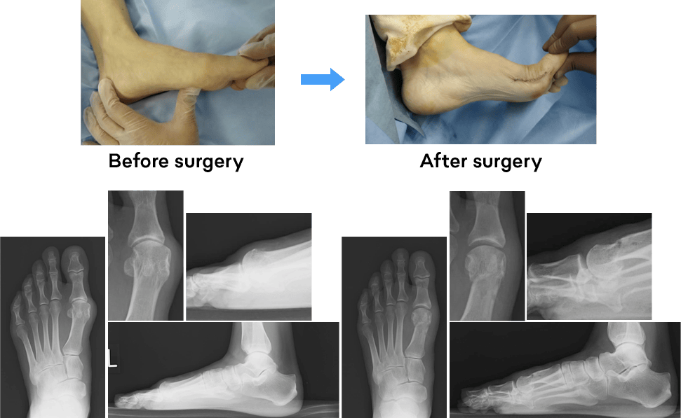 Surgery for hallux rigidus