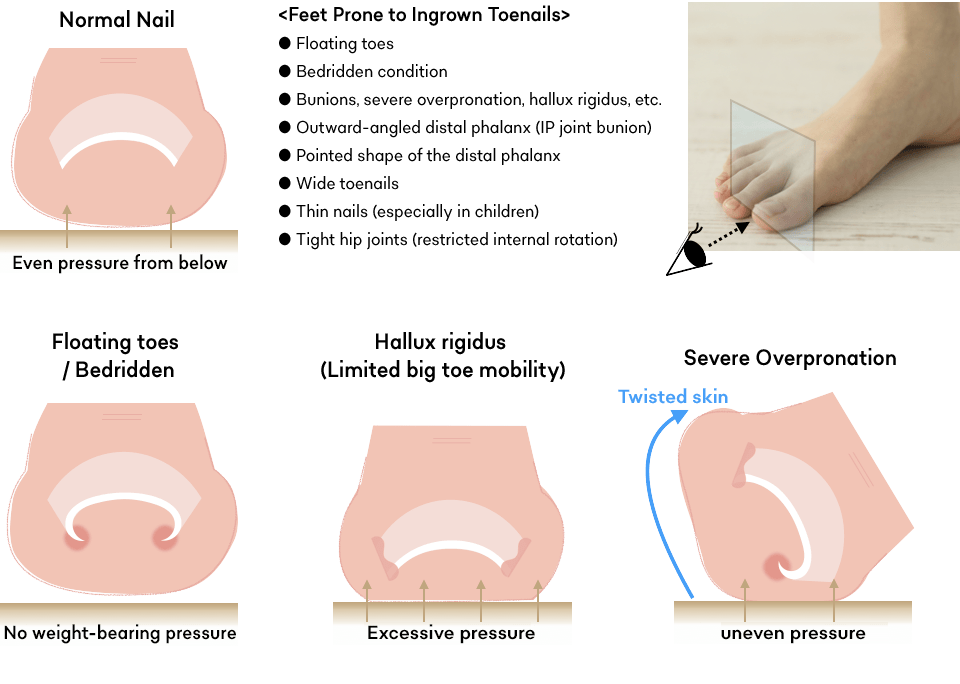 Mechanism of Ingrown Toenail