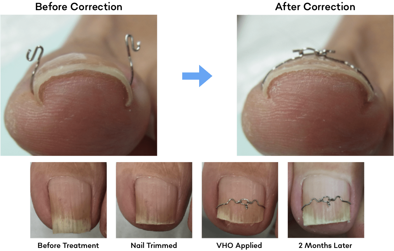 VHO Wire Correction