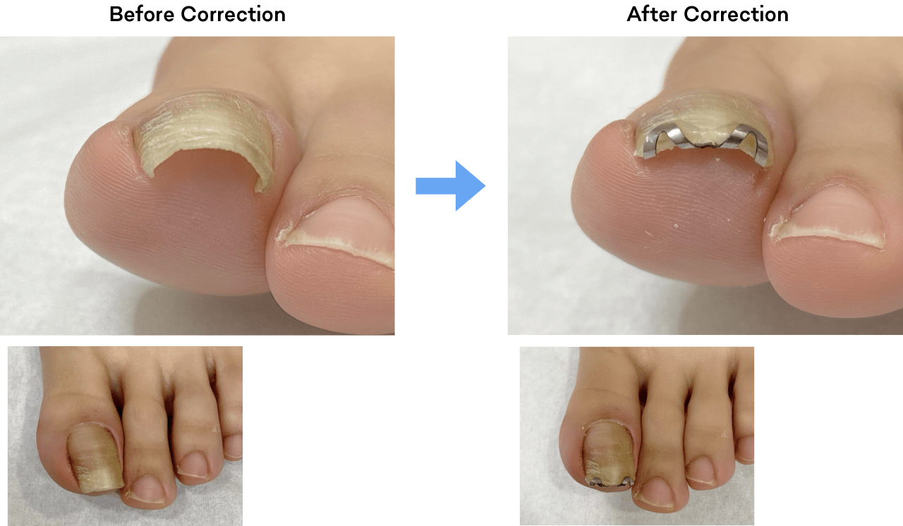 Nail Aid Correction