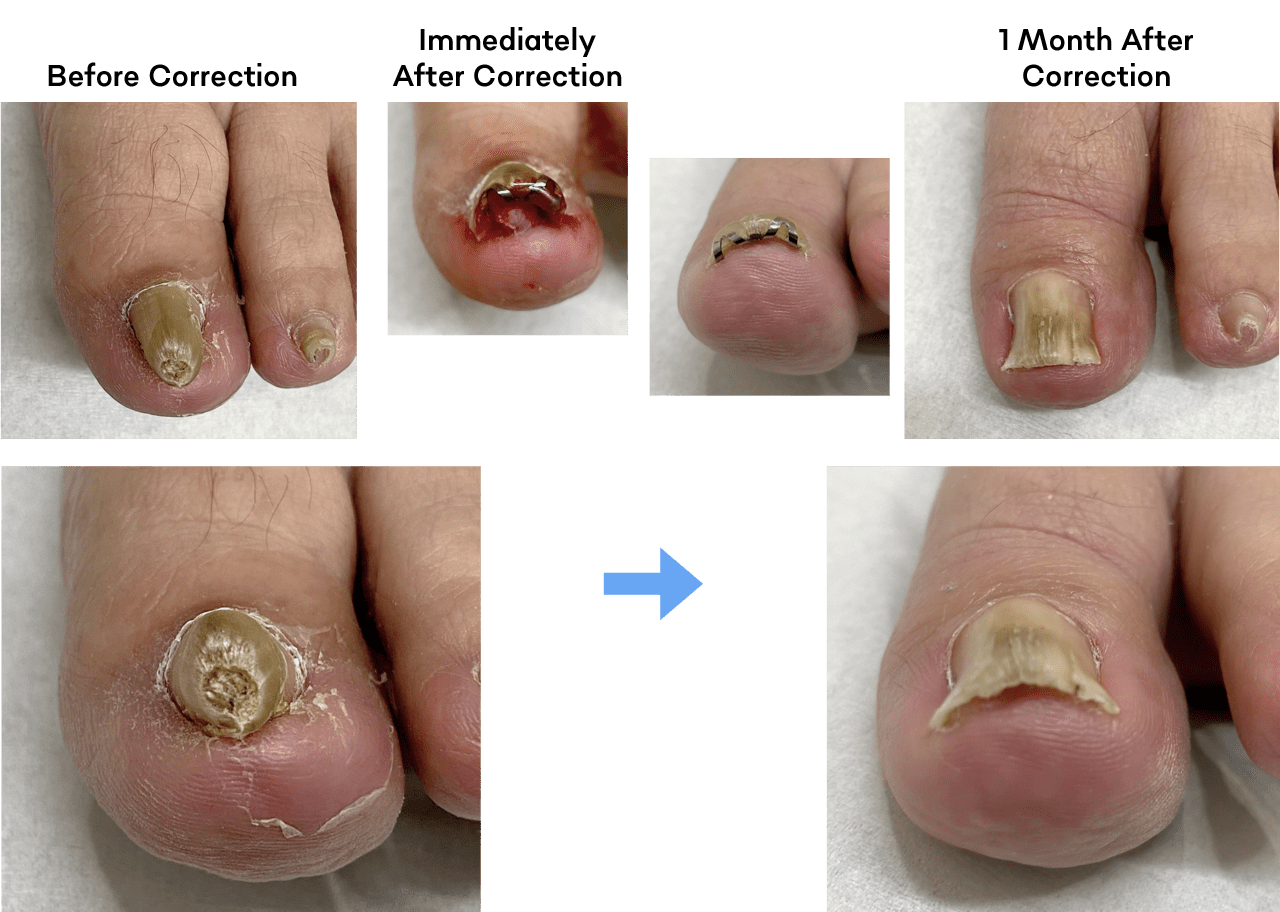 Correction Under Local Anesthesia