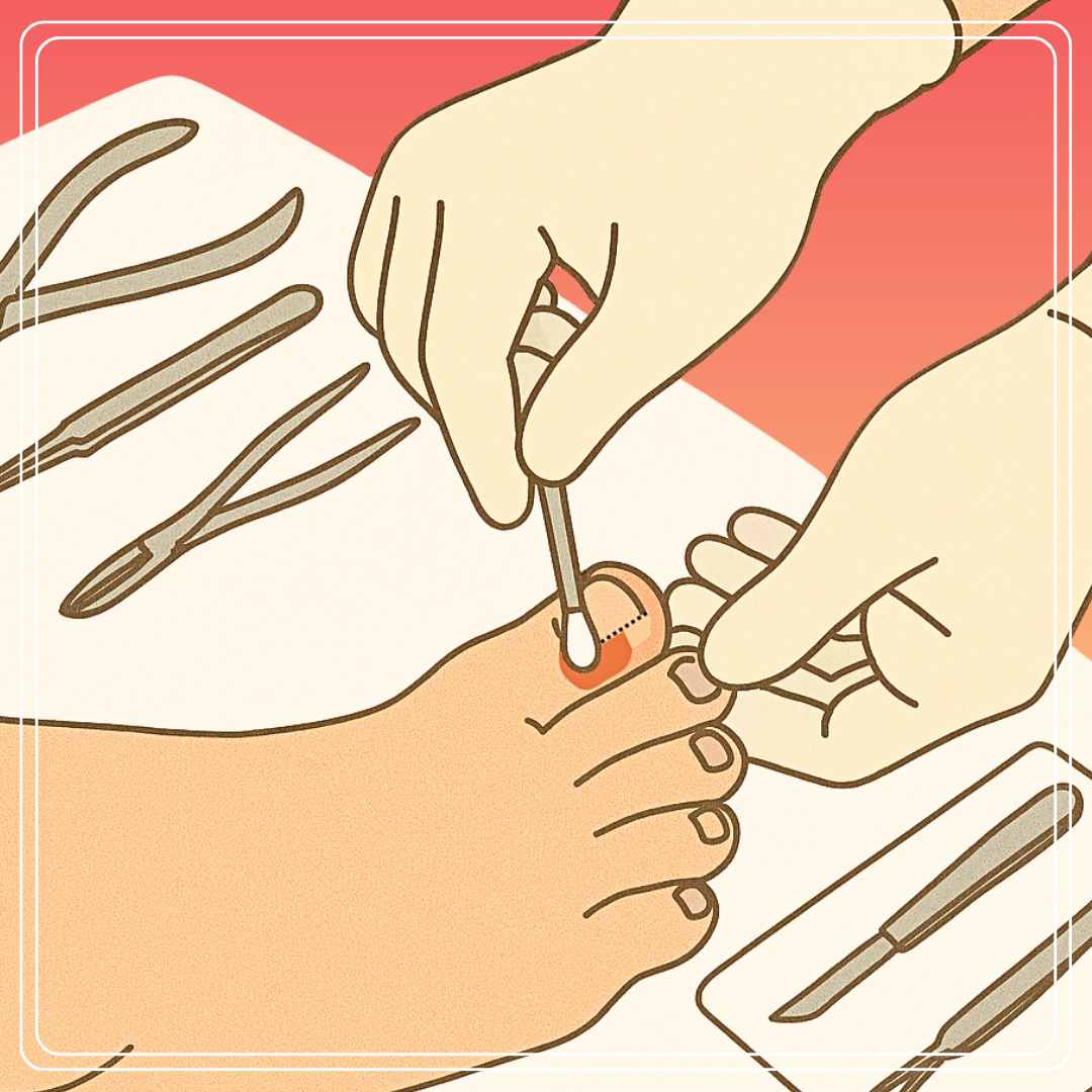 surgery for an ingrown toenail